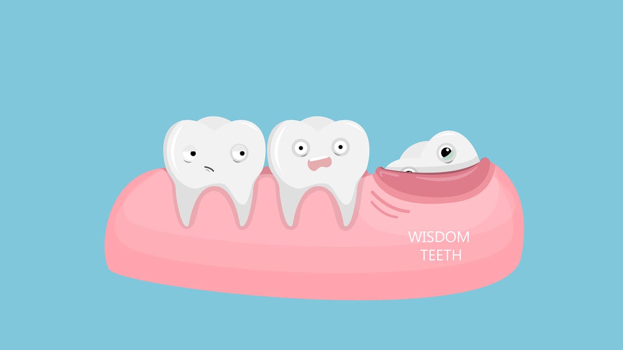 wisdom teeth before and after