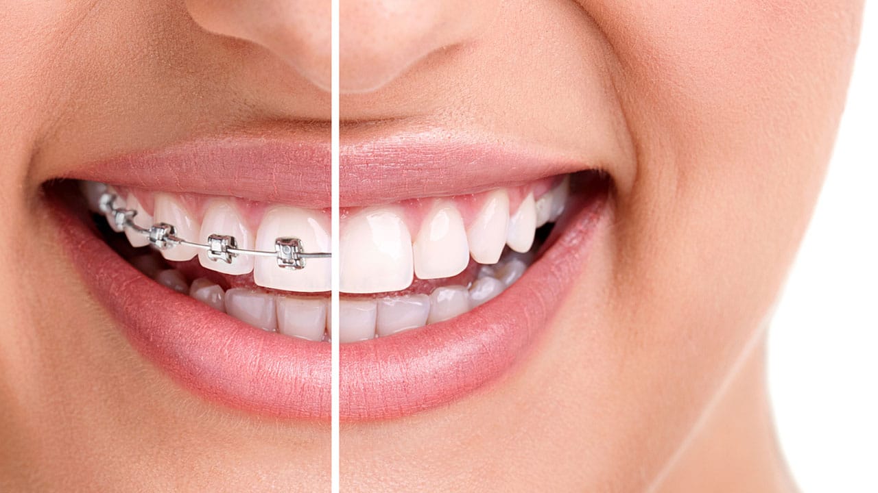 Getting Your Braces Off? Here&#39;s What to Expect! - College Drive Dental Associates